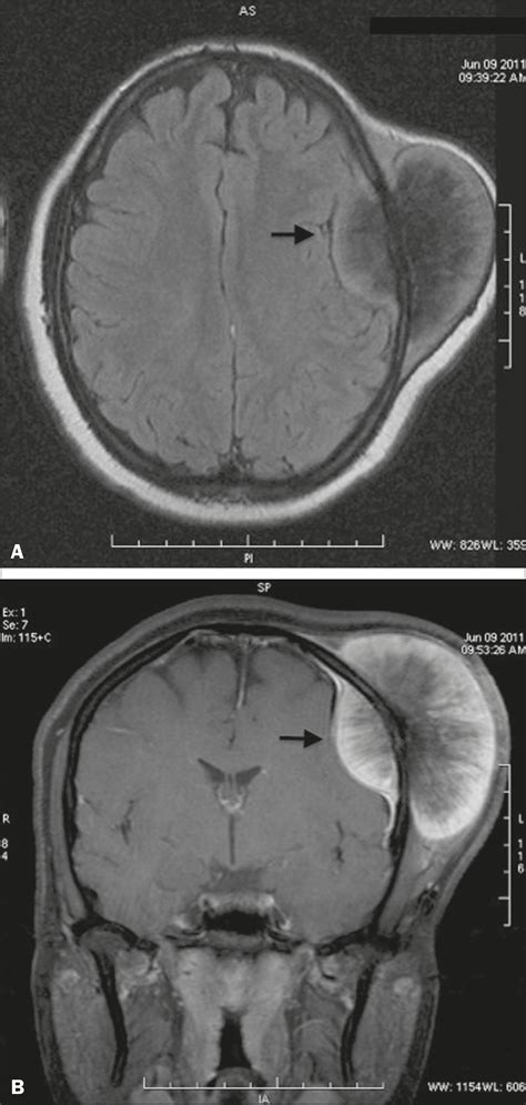 Scielo Brasil Primary Osteosarcoma Of The Cranial Vault Primary