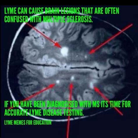 Lyme Disease Mri Brain Lesions