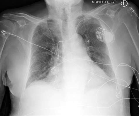 Pulmonary Oedema Chest X Ray Medschool