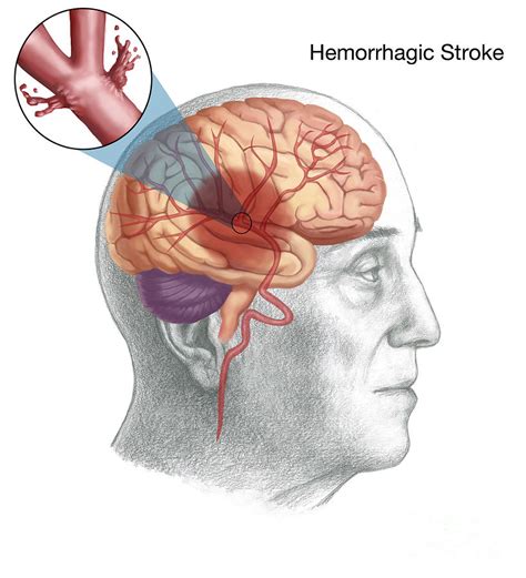 Hemorrhagic Stroke Photograph By Spencer Sutton Pixels