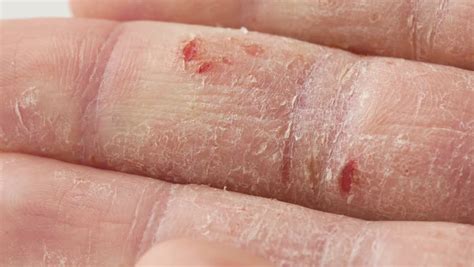 Atopic Dermatitis Footage Videos And Clips In Hd And 4k