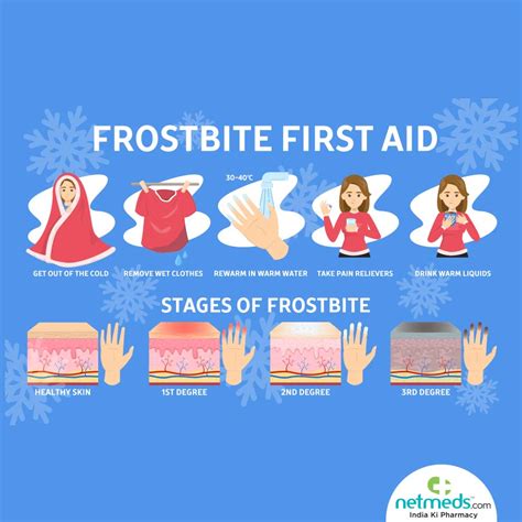 Frost Bite Causes Symptoms And Treatment Netmeds