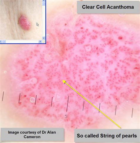Dermoscopy Made Simple Clear Cell Acanthoma