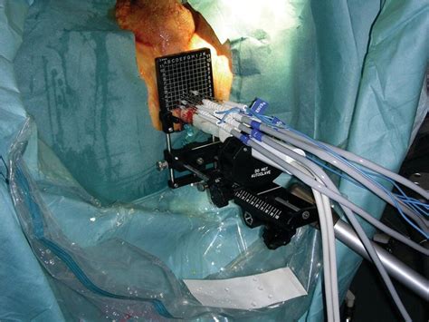 Cryotherapy Of The Prostate Abdominal Key