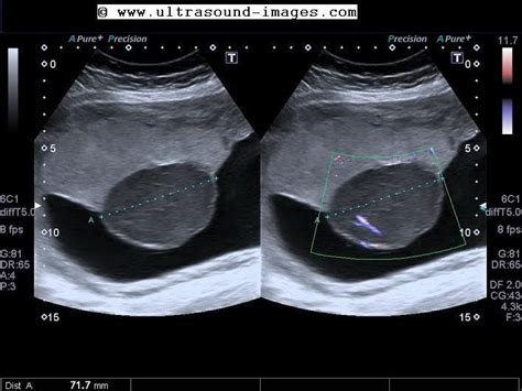 A Variety Of Ultrasound Images Of The Placenta As Seen In Various