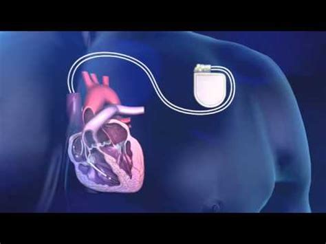 An icd delivers an electrical shock to the heart during a life threatening heart rhythm. Implantatie van een ICD - Medtronic - YouTube
