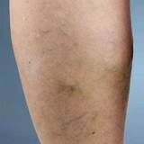 Doctor Who Specializes In Veins Photos