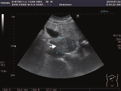 Abdominal Ultrasound Demonstrating A Liver Tumor Of Size 59 Â 57 Cm