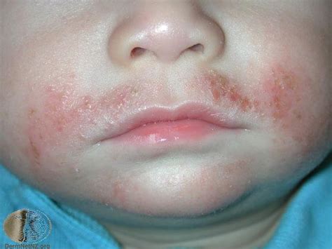 Common Skin Rashes And What To Do About Them Frazer Institute
