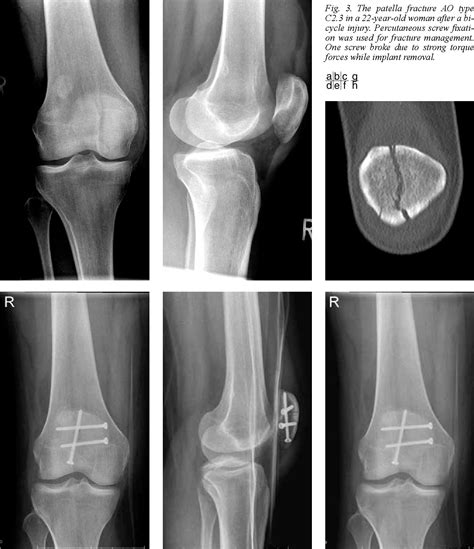 Figure 3 From Patellar Fractures A Review Of Classification Genesis