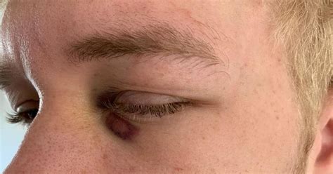 Teenager Suffers Fractured Eye Socket In Unprovoked Attack On Night Out Manchester Evening News