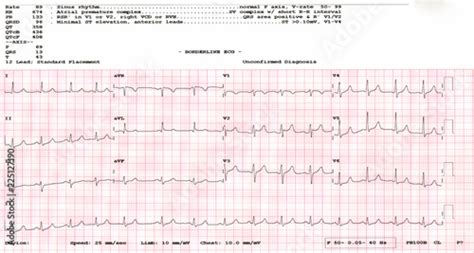 Cardiogram Waveform From An Ekg Showing Borderline Ekg Test Stock