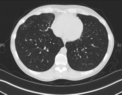 Doctors can use a ct scan to look for lung cancer. Scan Week | The Nodule Project