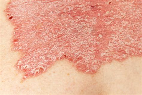 Psoriasis Stock Photos Pictures And Royalty Free Images Istock