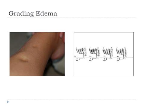 Pitting Edema Scale