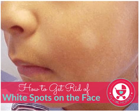 white patches on skin how to cure white patches on skin any part of the body vitiligo