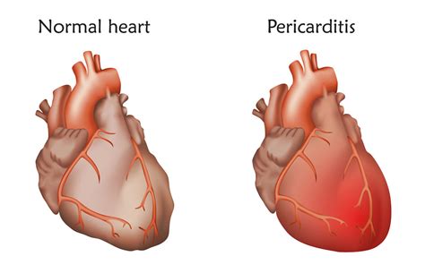 Know Pericarditis Symptoms Causes And Treatment Dr Raghu