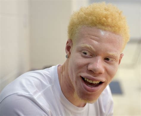 Black Albino Hot Sex Picture