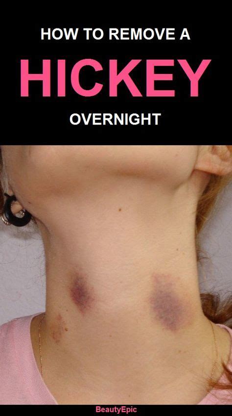 top 10 easy ways to get rid of a hickey overnight hickeys hickies hickies neck