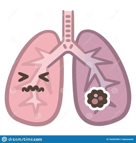 Normal Lung And Lung Cancer Illustration Stock Vector Illustration Of