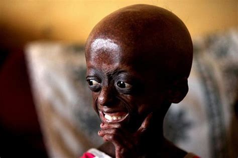 Ontlametse Phalatse Progeria Viva Communications