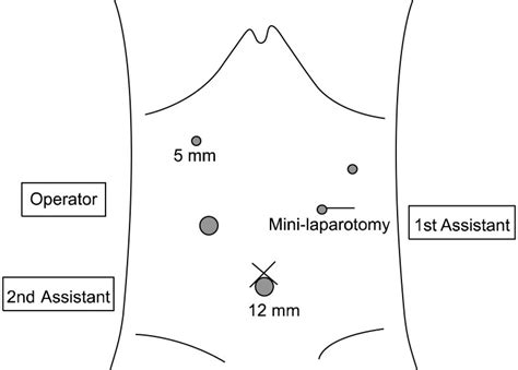 Ports Placement For Laparoscopy Assisted Total Gastrectomy With