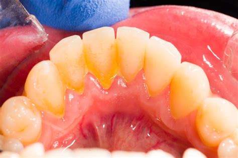 Plaque entfernen Mundspülung gegen Zahnbelag selber machen