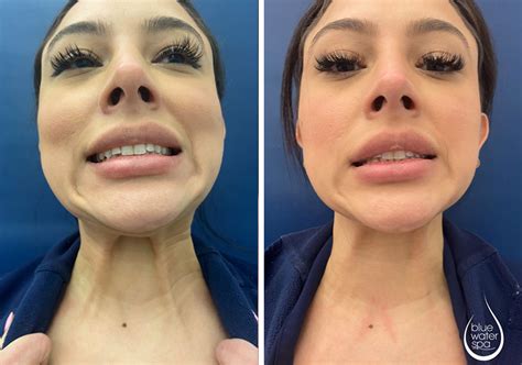 Platysmal Band Botox Neck Botox Before And After