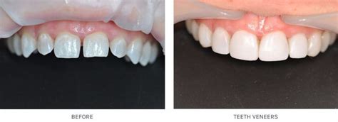 Same Day Veneers Near Me - My Amelia
