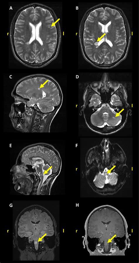 Brain Mri Shows Multiple Supratentorial A C And Infratentorial D H