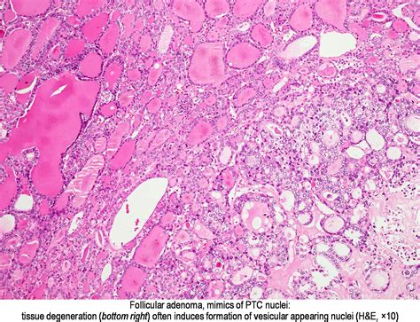 Pathology Outlines Papillary Thyroid Carcinoma