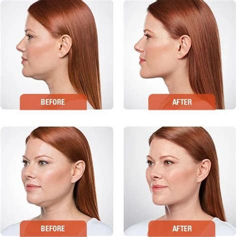 Get Rid Of Double Chin With Botox Treatment At Rs 20000chennai In