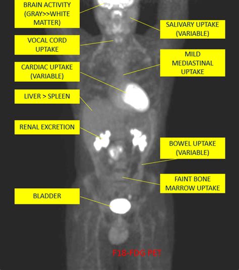 The management of cancer has evolved over the years to include many modalities of treatment such as surgery, chemotherapy and radiation therapy. NucRadSHARE Kamal Singh