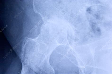 Osteoarthritis Of The Hip X Ray Stock Image M1100673 Science