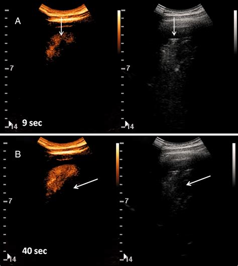 Contrast‐enhanced Ultrasound In Patients With Covid‐19 Soldati 2020
