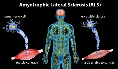 Amyotrophic Lateral Sclerosis Als Natures Way Medicinenatures Way