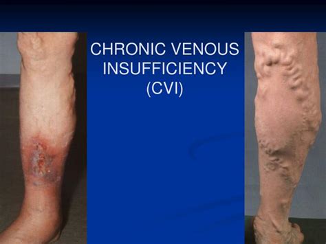 Ppt Chronic Venous Insufficiency Cvi Powerpoint Presentation Free