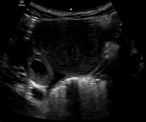 [figure this image demonstrates an ectopic pregnancy via ultrasound contributed by kenn