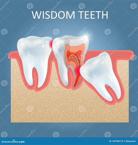 Wisdom Teeth Problems Vector Poster Design Template Stock Vector