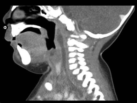 G72p Extensive Retropharyngeal And Mediastinal Abscess Formation By