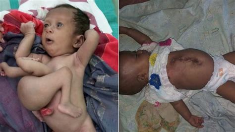 הודו תינוקת נולדה עם 4 רגליים ונותחה