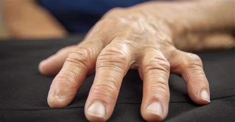 Since we use our hands and fingers in most activities, arthritis in the hands can be a cause of discomfort and uneasiness. Symptoms of Rheumatoid Arthritis in the Hands and Fingers ...
