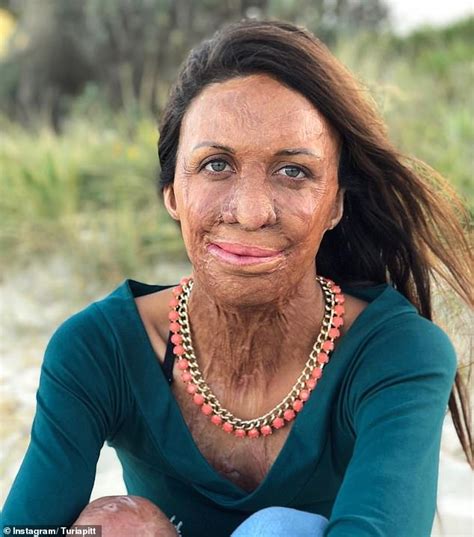 Inspirational Burns Survivor Turia Pitt Admits She Lost Friends After Bushfire Almost Killed Her
