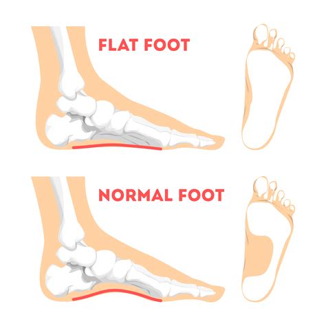 Flat Feet Treatments Pain Causes Symptoms Seaview Orthopaedics