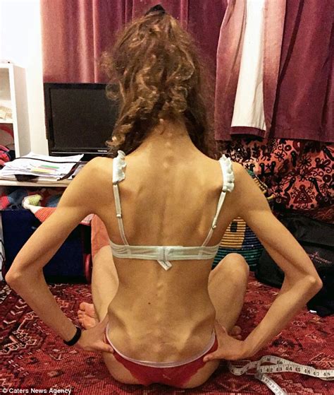Four Stone Anorexic Ballet Dancer Who Survived On Just Calories A