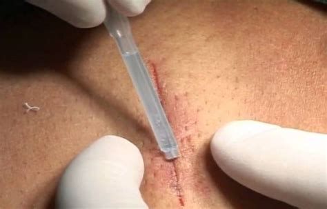 Suturer une plaie méthodes et délai de retrait des points de suture