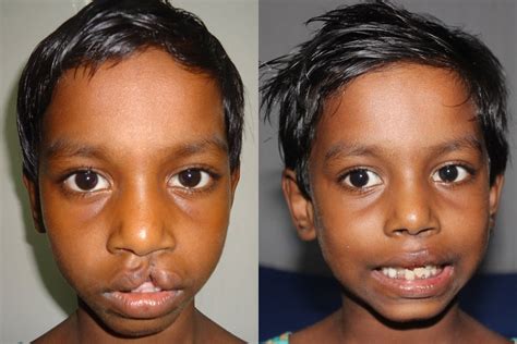 Cleft Lip And Palate Surgery Dr Bijoy Krishna Das