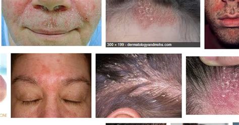 Seborrheic Dermatitis Hair Loss Temporary Washington Dc About Me
