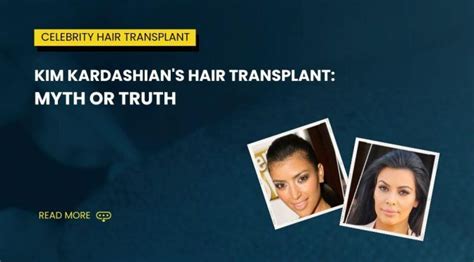 Kim Kardashian Hair Transplant Bluemagic Group Clinic