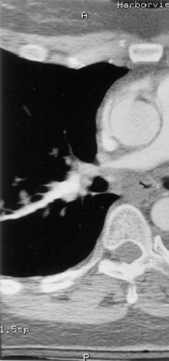 Treatment Of Pulmonary Artery Compression Due To Fibrous Mediastinitis